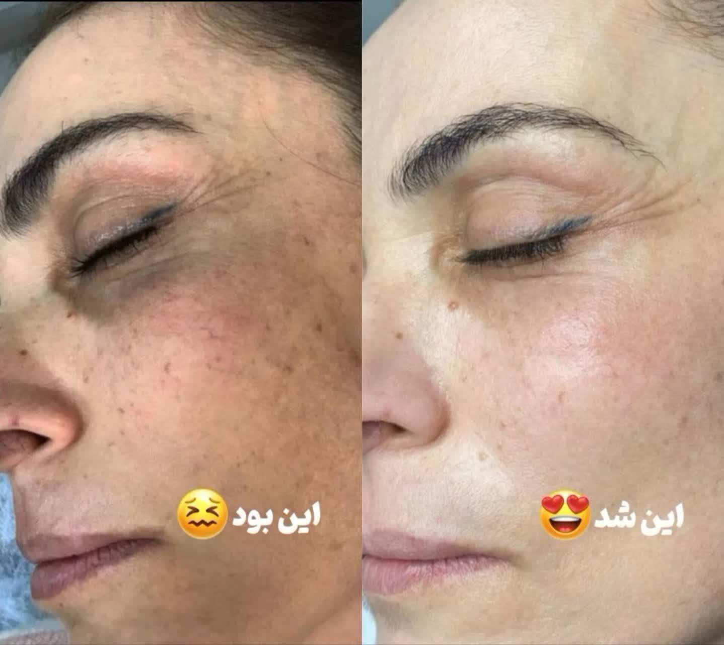 نتیجه درمان جوش